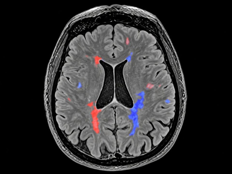 Resonancia Magnética de Cuantificación de Lesiones Esclerosis Múltiple