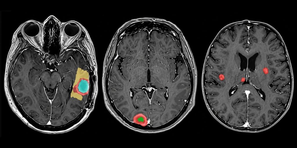 Resonancia Magnética de Segmentación Tumoral Cerebral